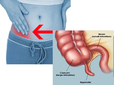 Laparoscopic surgery for Appendix