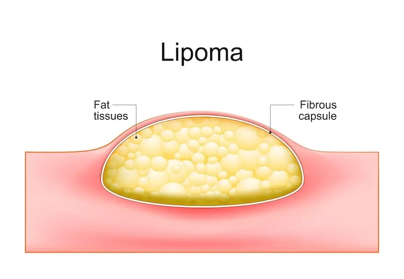 illustration of lipoma