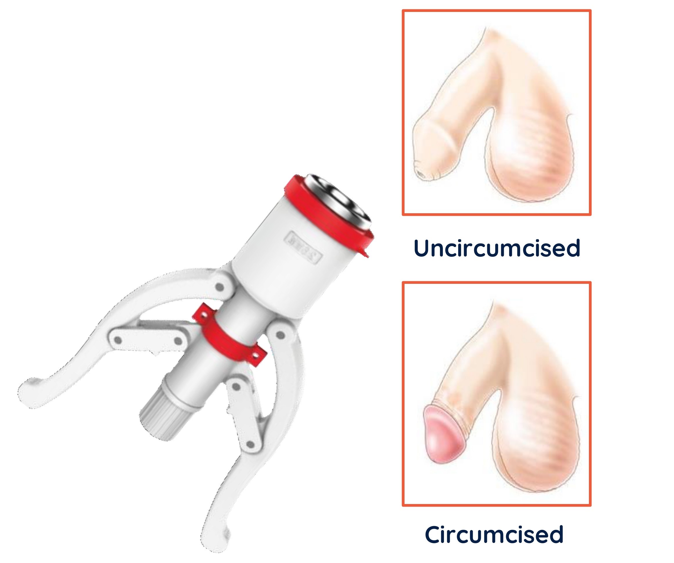 Circumcision Treatment