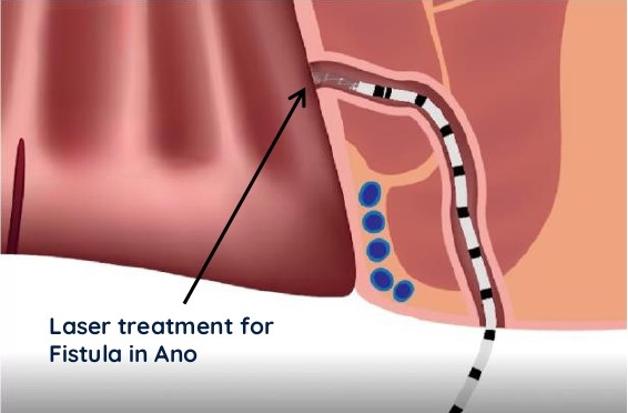 fistula treatment in mumbai