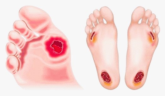 Diabetic foot treatment