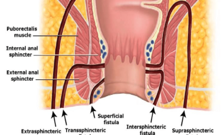 Fistula in ano