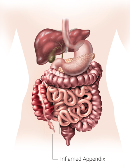 Best Laparoscopic Surgery For Appendix in Dadar - DLPC