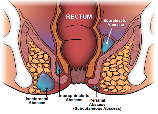 Perianal abscess treatment mumbai