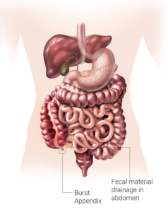 Ruptured Appendicitis