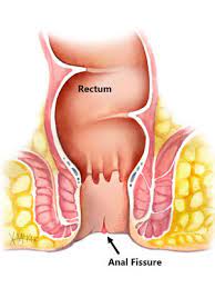 Laser Treatment for Anal Fissure