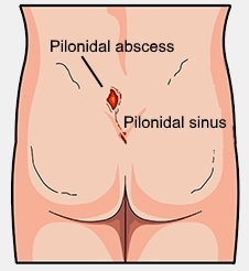 pilonidal disease healthinfo 226x246 1