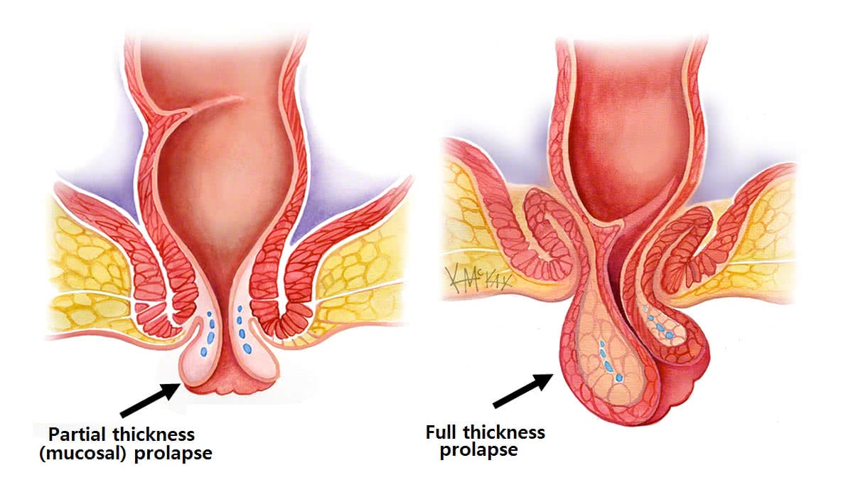 rectal prolapse surgery page 2