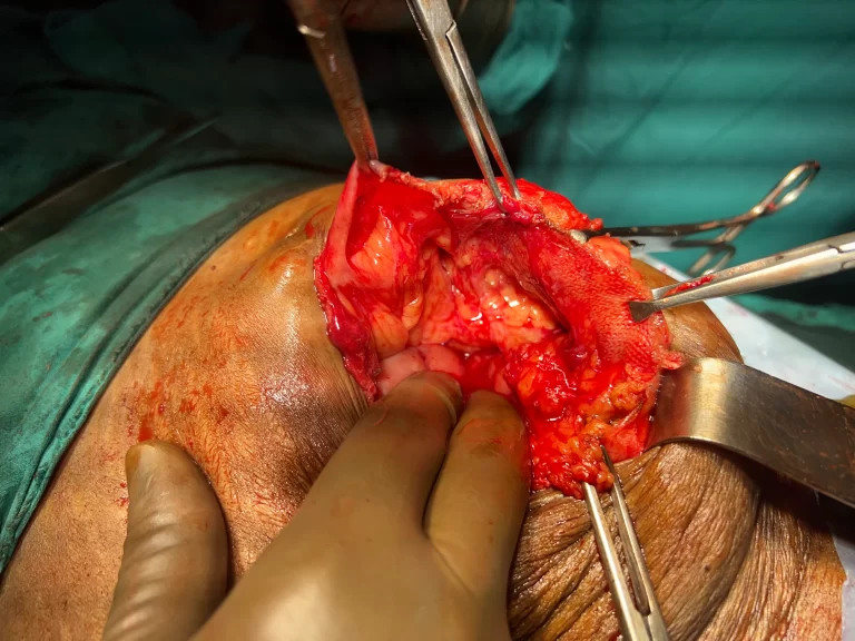 Adhesions of mesh with viscera